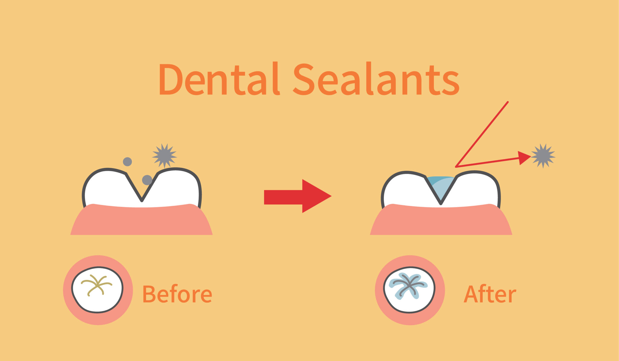 Sealants They’re Not Just for Kids!