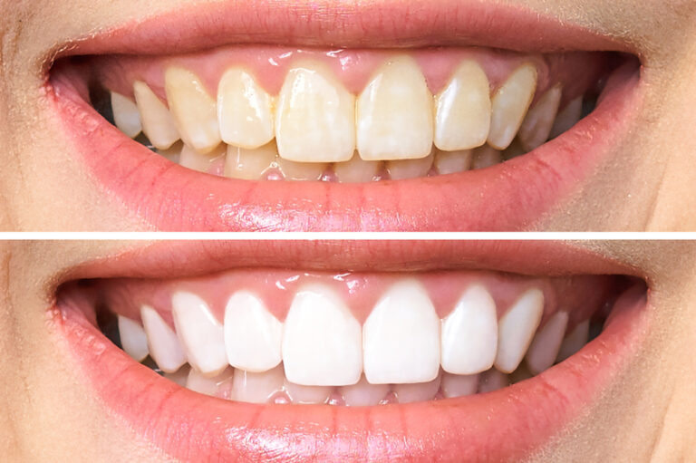 can-i-whiten-the-appearance-of-old-crowns-and-other-dental-work