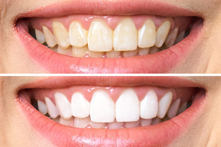 Can I Whiten The Appearance Of Old Crowns And Other Dental Work 