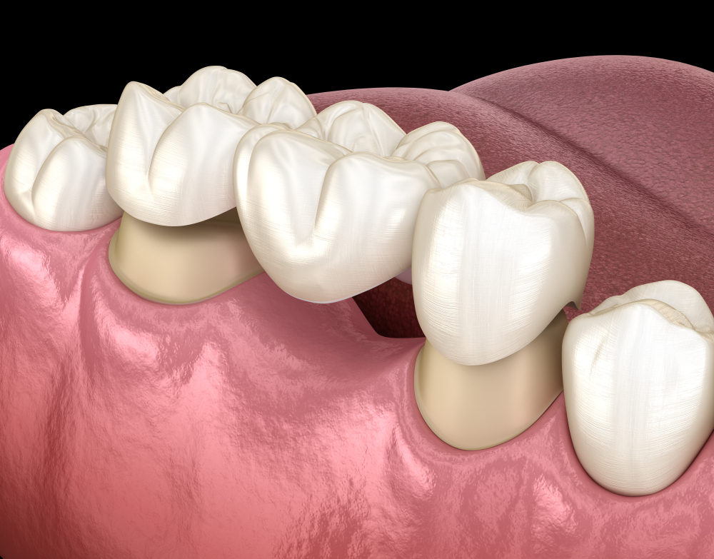 How Does a Dental Bridge Work?