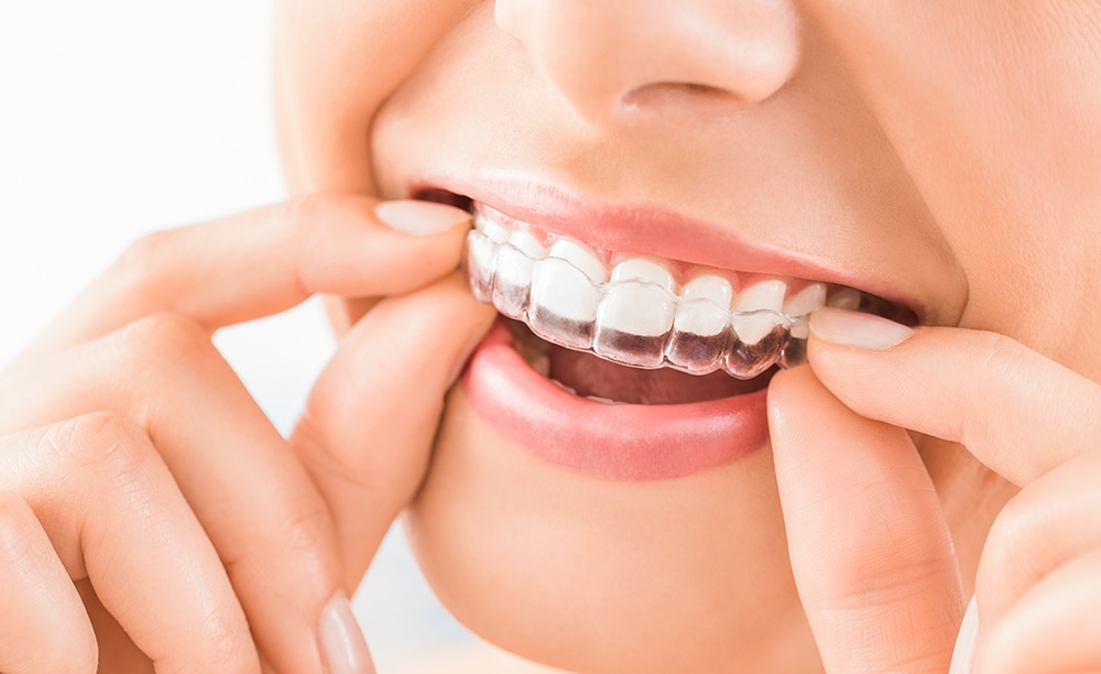 Why Invisalign is Faster than Braces